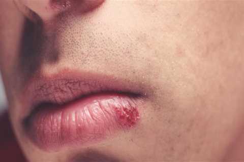 Understanding and Using Tea Tree Oil for In-Mouth Herpes