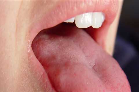 Tingling Sensation in the Mouth: An Overview