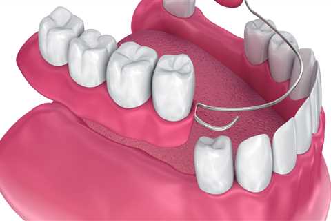 What Type of Dentures is Best for Missing Teeth?