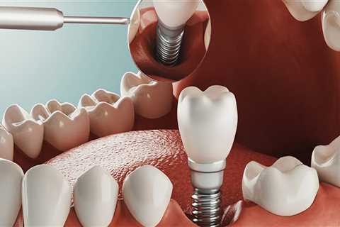 Exploring Alternatives to All-on-Four Dental Implants