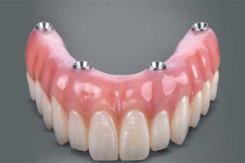 Are All-on-Four Dentures Removable?