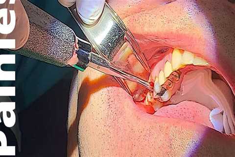 What are the Steps of Tooth Extraction? A Comprehensive Guide