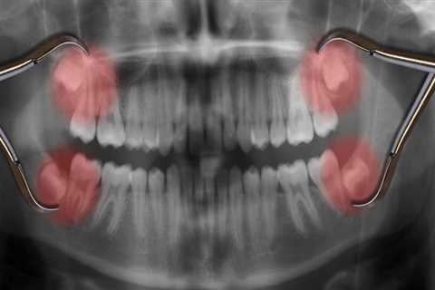 Should You Remove All 4 Wisdom Teeth at Once?