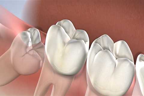 What is Wisdom Teeth Removal? A Comprehensive Guide