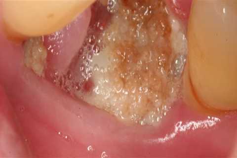 Signs of Infection After Tooth Extraction