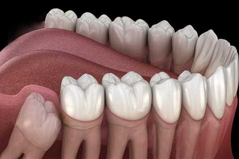 The Benefits of Removing Wisdom Teeth: A Comprehensive Guide