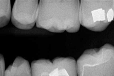 How often should dental x-rays be taken?