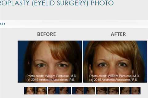 The Seattle Eyelid & Blepharoplasty Center