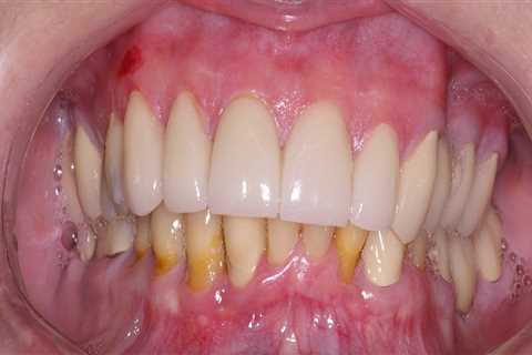 Do veneers permanently damage teeth?
