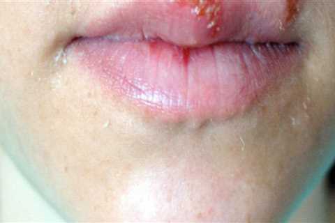 Complications of Oral Herpes Infection