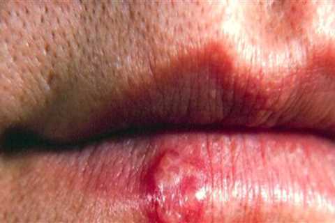 Complications of Untreated Oral Herpes