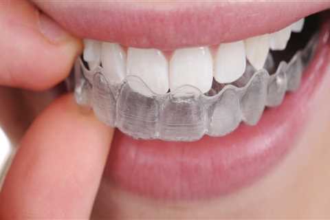 Are Clear Teeth Aligners Safe and Effective?