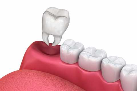 About Tooth Extractions