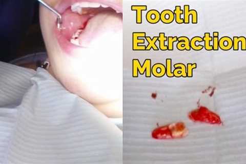 What Does Tooth Extractions Mean?