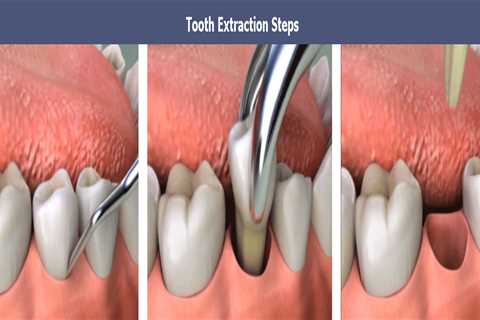 The Ultimate Guide To Tooth Extractions