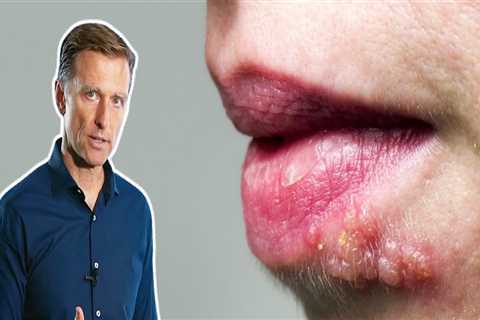 Eating a Balanced Diet for Herpes Symptoms Management