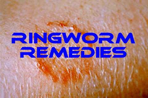 10 Home Remedies for Ringworm - Home Remedies App
