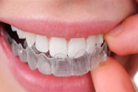 The Modern Approach To Straight Teeth: Invisalign Clear Braces In London