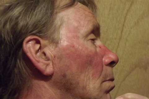 10 Home Remedies for Rosacea - Home Remedies App