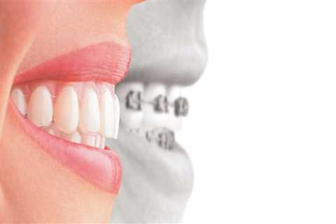 Straighten Your Teeth With Invisalign: Finding The Right Dentist In Taylor, TX
