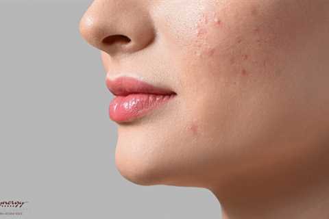 Top 5 Medspa Treatments for Acne-Prone Skin