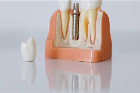 Revolutionizing Tooth Replacement: Mcgregor's All-on-four Dentures And Dental Implants