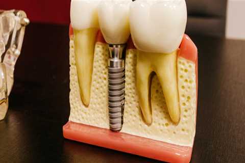 The Benefits Of Teeth Implants In Dripping Springs, TX: Beyond Aesthetics