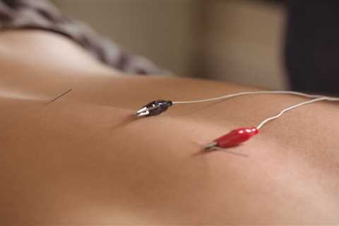 INTRODUCTION TO ACUPUNCTURE TOOLS
