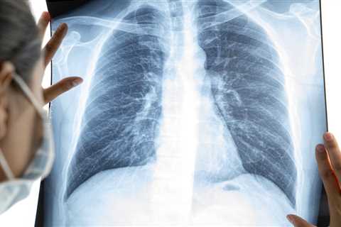 New AI tech to be rolled out at 64 NHS hospitals to help spot deadly lung cancer faster