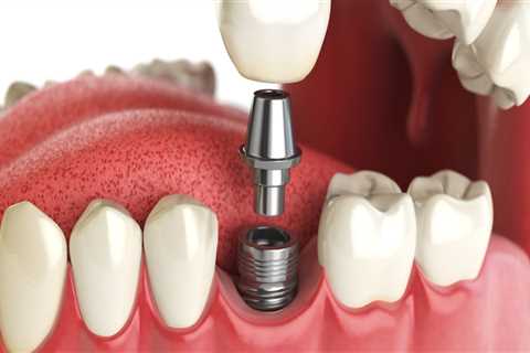 Which is the best type of dental implants?