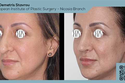 Standard post published to Dr. Demetris Stavrou - European Institute of Plastic Surgery - Nicosia..