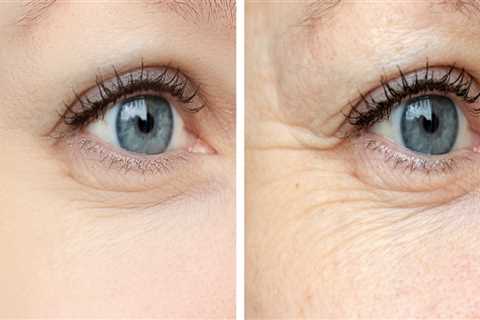 All you need to know about Under Eye Wrinkles and Fine Lines