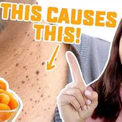 Stop Eating These 5 Healthy Foods That Cause Skin Tags! (Acrochordons)