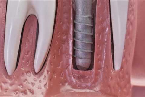How long does it take for dental implants to stop hurting?