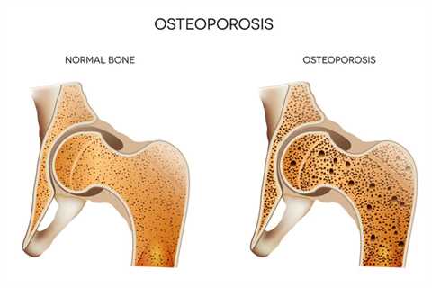 Does Creatine Enhance Bone Properties in Post-Menopausal Women?