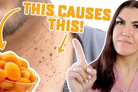 Stop Eating These 5 Healthy Foods That Cause Skin Tags! (Acrochordons)