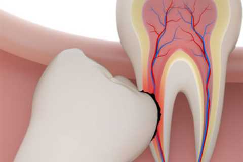 Wisdom Teeth Removal | Perth, Belmont, Cloverdale, Burswood