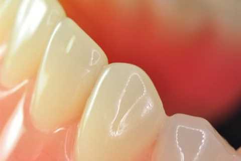 Dentures Perth - Fitting By Qualified And Experienced Dentists