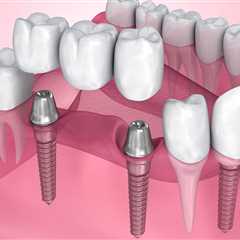 Why dental implants are important?