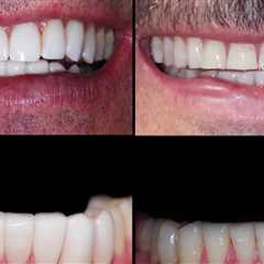 How many dental visits do you need for veneers?