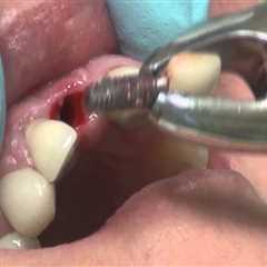 Can dental implants be removed?