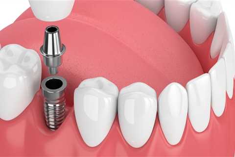 Can dental implants make you sick?