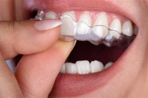 Understanding Clear Aligners: Their Function and Importance in Orthodontics