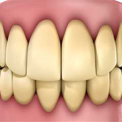 Understanding the Causes of Tooth Discoloration