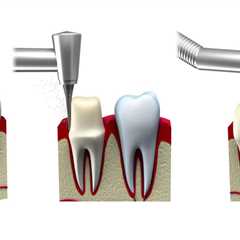 Steps to Getting a Dental Crown: What You Need to Know