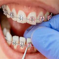 Steps for Getting Orthodontic Treatment