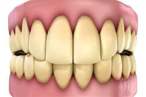 Understanding the Causes of Tooth Discoloration