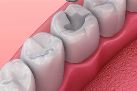 Understanding the Different Types of Dental Fillings