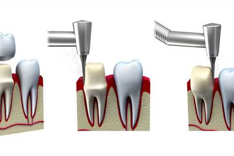 Steps to Getting a Dental Crown: What You Need to Know