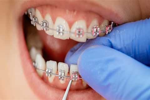 Steps for Getting Orthodontic Treatment